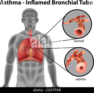 Tube bronchique à inflammation d'asthme Illustration de Vecteur