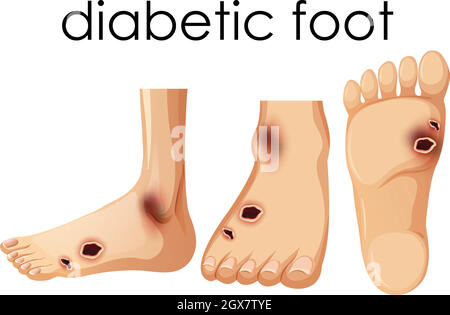 Pied humain diabétique Illustration de Vecteur