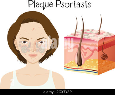 Anatomie humaine du psoriasis en plaques Illustration de Vecteur