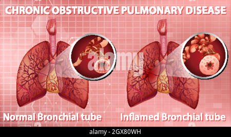 La maladie pulmonaire obstructive chronique Illustration de Vecteur