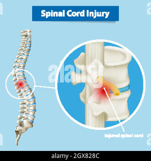 Schéma montrant une lésion de la moelle épinière Illustration de Vecteur