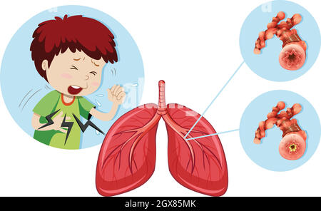Un homme ayant une maladie pulmonaire obstructive chronique Illustration de Vecteur