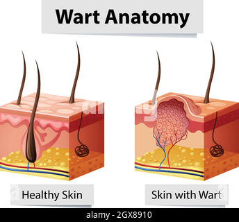 Illustration de l'anatomie de la peau humaine verrue Illustration de Vecteur