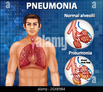 Comparaison d'alvéoles saines et de pneumonie Illustration de Vecteur