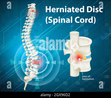 Schéma illustrant le disque hernié Illustration de Vecteur