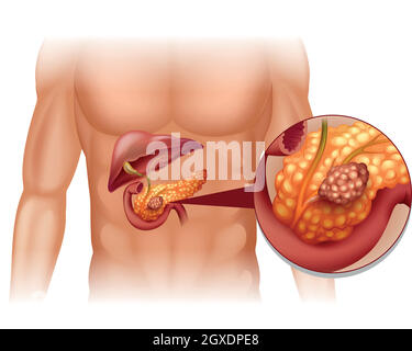 Cancer du pancréas dans le corps humain Illustration de Vecteur