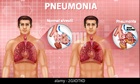 Comparaison d'alvéoles saines et de pneumonie Illustration de Vecteur