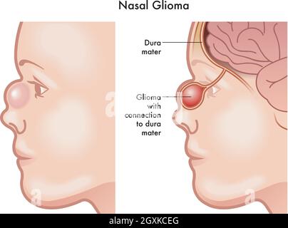 Illustration médicale des symptômes d'un gliome nasal sur un bébé, avec des annotations. Illustration de Vecteur