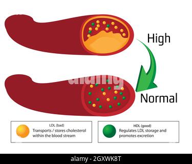 Transformer le niveau élevé de plaque athérosclérotique dans les vaisseaux sanguins en niveau normal. Infographies de vecteur médical Banque D'Images