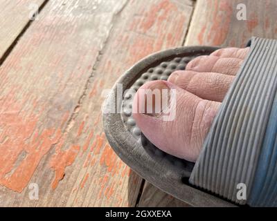 Ongles endommagés par les champignons sur le pied droit Banque D'Images