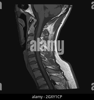 Image sagittale réaliste du rachis cervical avec scanner, IRM couche d'imagerie par résonance magnétique du cou du rachis. Isolé sur fond sombre. Vecteur illus Banque D'Images