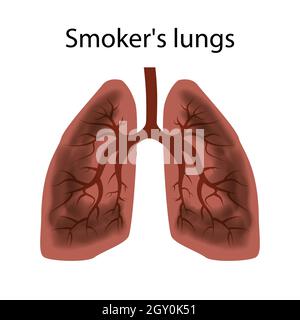 Poumons du fumeur. Les dommages aux poumons d'une personne causés par le tabagisme. Vecteur isolé EPS10. Banque D'Images