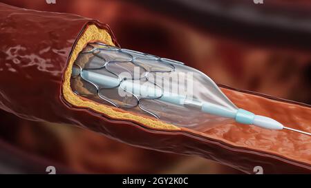 Illustration du rendu 3D de l'angioplastie.Pose d'un stent avec ballonnet dilaté dans une artère ou un vaisseau sanguin malade obstrué par du cholestérol ou un athérome Banque D'Images