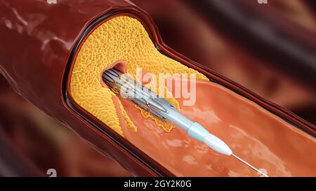 Illustration du rendu 3D de l'angioplastie.Pose de stent avec ballonnet collapsé dans une artère ou un vaisseau sanguin malade obstrué par du cholestérol ou de l'athero Banque D'Images