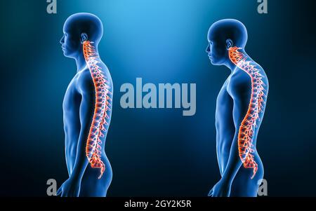 Comparaison entre la courbure normale de la colonne vertébrale et la cyphose avec le modèle mâle à partir de l'illustration de rendu 3D de vue latérale.Anatomie humaine, disor spinal Banque D'Images