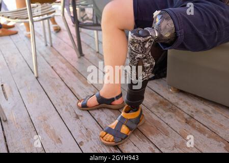 Nouvelles prothèses de jambes en aluminium pour patient amputé Banque D'Images