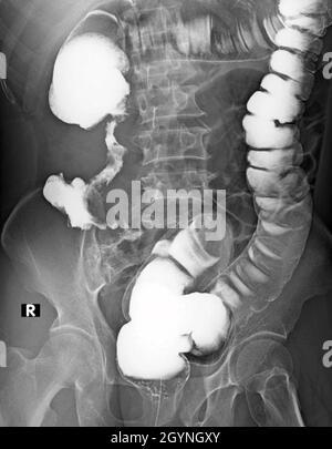 Cancer colorectal, radiographie Banque D'Images