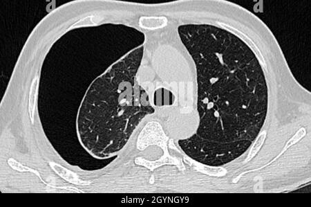 Pneumothorax, scanner Banque D'Images