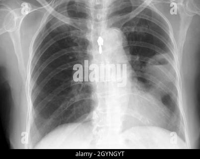 Abcès pulmonaire, rayons X. Banque D'Images