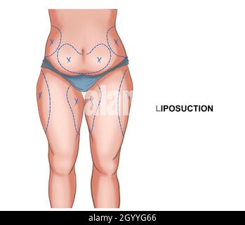 illustration du corps avant et après la perte de poids ou la liposuccion Banque D'Images