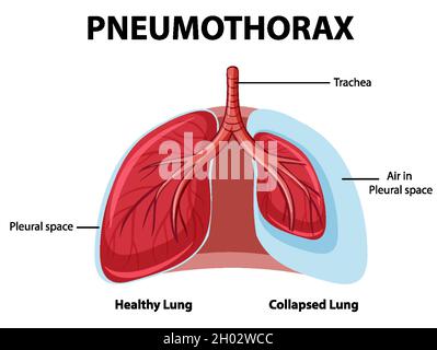 Schéma pneumothorax avec poumon collabé et poumon sain Illustration de Vecteur