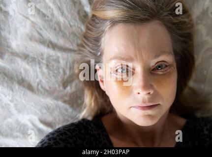 Femme d'âge moyen, selfie sept jours après une double blépharoplastie. Banque D'Images