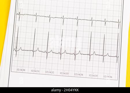 Gros plan de l'ECG, électrocardiogramme.Le travail d'un coeur sain sur le papier. Banque D'Images