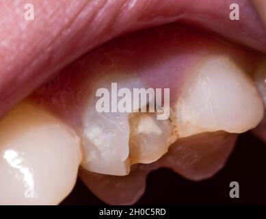 Une dent morte noire dans laquelle un morceau d'émail de dent est ébréché, une puce de dent. Le concept de la restauration dentaire dans la dentisterie moderne, macro. Orthod Banque D'Images