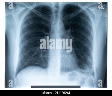 Image radiographique du thorax humain pour un diagnostic médical.Concept médical minimal. Banque D'Images