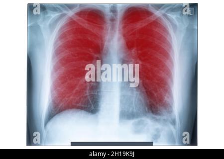 Image radiographique du thorax humain pour un diagnostic médical.Coronavirus-COVID-19.Virus épidémique 2019-nCoV syndrome respiratoire.Concept de médecine. Banque D'Images