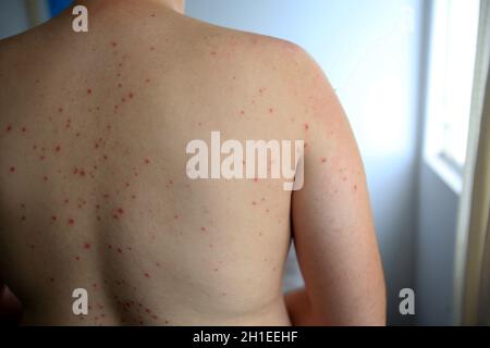 salvador, bahia / brésil - 11 avril 2019 : l'homme montre des parties du corps infectées par des symptômes du syndrome des mains et des pieds et de la bouche, connu sous le nom de Roseola. *** Loc Banque D'Images