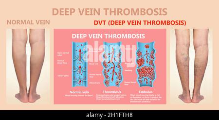 Thrombose veineuse profonde ou des caillots de sang. Embolie gazeuse. Structure de la normale et les varices veines femelle Banque D'Images