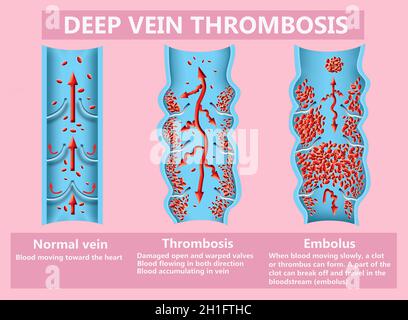 La thrombose. De la normale de la circulation sanguine vers la formation de caillots sanguins et clot, qui voyage dans le sang. L'embolie. Illustration pour la biologie, le medi Banque D'Images