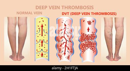 Thrombose veineuse profonde ou des caillots de sang. Embolie gazeuse. Structure de la normale et les varices veines femelle Banque D'Images