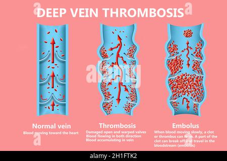 La thrombose. De la normale de la circulation sanguine vers la formation de caillots sanguins et clot, qui voyage dans le sang. L'embolie. Illustration pour la biologie, le medi Banque D'Images