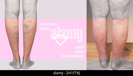 Collage des varices et du membre inférieur hyperpigmenté secondaire à l'insuffisance veineuse. Banque D'Images