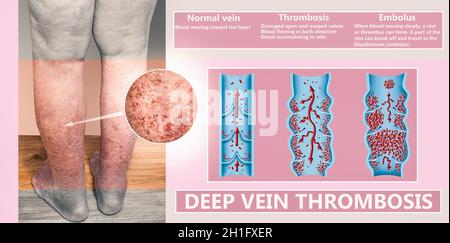 Collage des varices et du membre inférieur hyperpigmenté secondaire à l'insuffisance veineuse.L'illustration a été créée par moi Banque D'Images