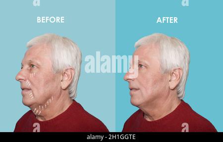 Le levage mâle avant et après les procédures en plastique Banque D'Images