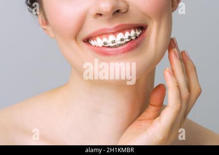 Traitement orthodontique.Concept de soins dentaires.Smile sain gros plan.Gros plan sur les supports en céramique et en métal des dents.Magnifique sourire féminin avec bretelles Banque D'Images