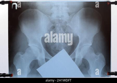 X-ray du bassin et du sacrum. X-ray image. Banque D'Images