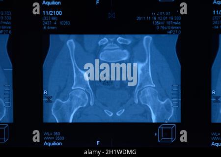 L'IRM de l'articulation sacro-iliaque. Étude de la spondylarthrite spondylarthrite sur patient. Les résultats de l'étude sur la x-ray. Banque D'Images