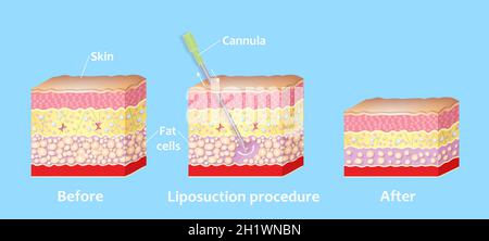 Mécanisme de liposuccion. Liposuccion assistée par aspiration. Tube creux ou canule, qui est inséré par une petite incision dans la peau afin de la graisse Banque D'Images