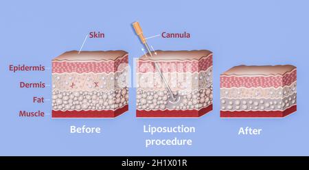 Mécanisme de liposuccion. Liposuccion assistée par aspiration. Tube creux ou canule, qui est inséré par une petite incision dans la peau afin de la graisse Banque D'Images
