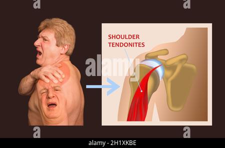Structure de l'articulation de l'épaule et tendonite de l'épaule.Le collage d'un homme âgé avec une douleur d'épaule sur fond noir.Concept de soins de santé Banque D'Images