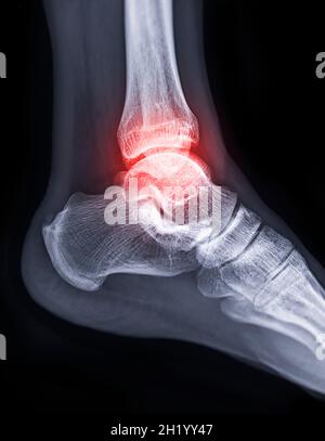 Image radiographique de l'articulation de la cheville montrant une fracture de l'articulation de la cheville. Banque D'Images