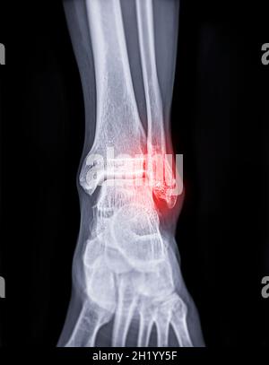 Image radiographique de l'articulation de la cheville montrant une fracture de l'articulation de la cheville. Banque D'Images