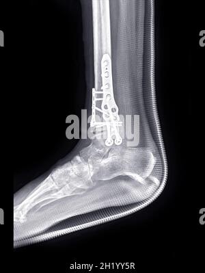 Image radiographique de l'articulation de la cheville montrant un traitement chirurgical par fixation interne avec plaque et vis. Banque D'Images