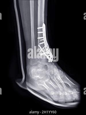 Image radiographique de l'articulation de la cheville montrant un traitement chirurgical par fixation interne avec plaque et vis. Banque D'Images