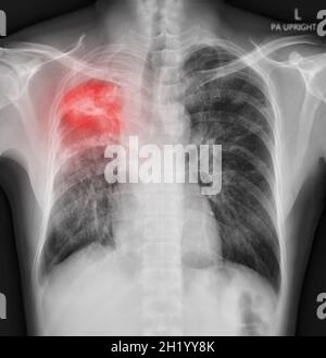 Radiographie thoracique du thorax ou du poumon humain montrant le poumon après détection du virus corona 2019. Banque D'Images