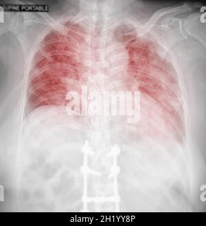 Radiographie thoracique du thorax ou du poumon humain montrant le poumon après détection du virus corona 2019. Banque D'Images